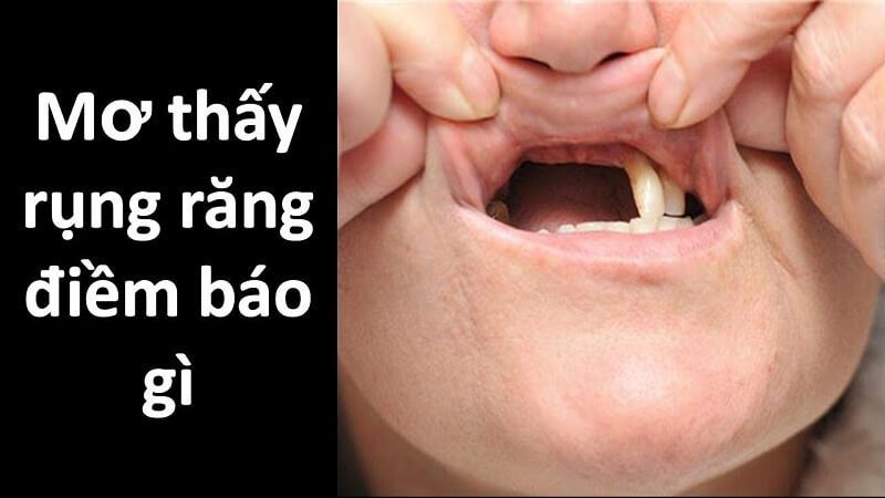 Mơ gãy răng là điềm gì? Giải mã giấc mơ thấy rụng răng